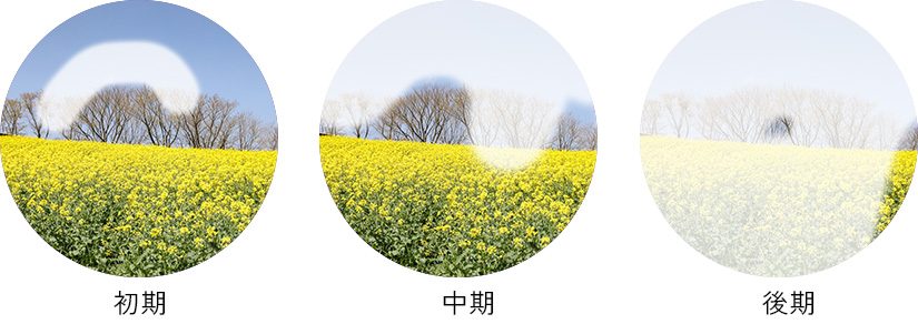 緑内障の見え方変化